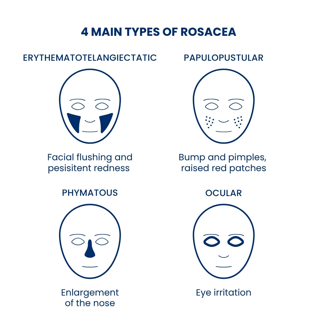 Diagram of the four main types of rosacea with face illustrations and descriptions.