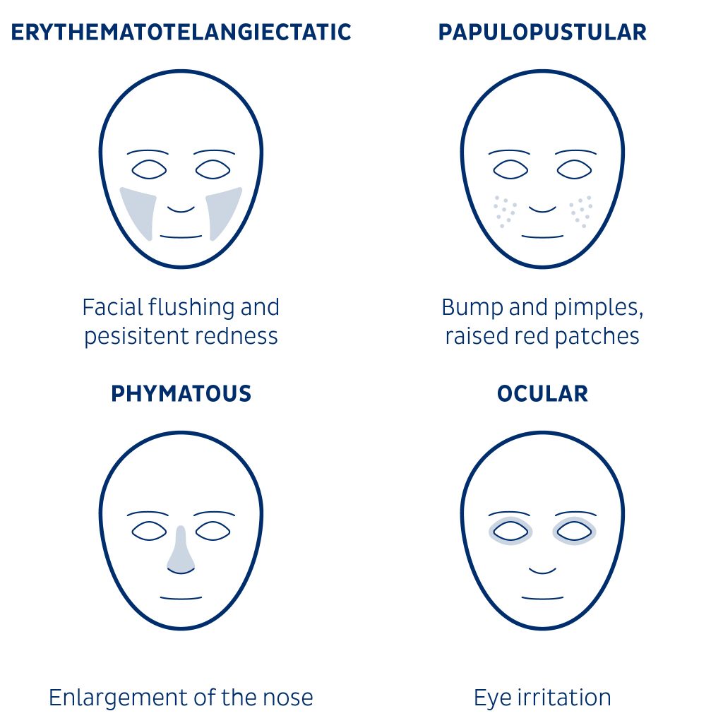 effective treatments for rosacea